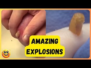 💥😱 Epic Pimple Popping Compilation: Flying Zits & Massive Cyst Explosions! 😱💥