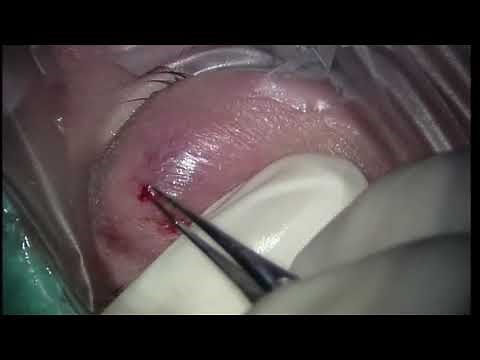 Eyelid Abscess Drainage