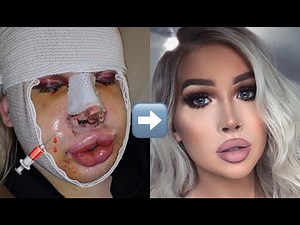 My Facial Feminization Surgery Story | Transgender FFS MTF