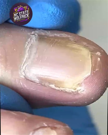 Gentle Nail Tips for Elderly Toenails For Long-Term Comfort #GentleToenailCare #SeniorNailCare #WellnessNails #SafeSteps | NC State Wolfpack on TheWolfpacker.com