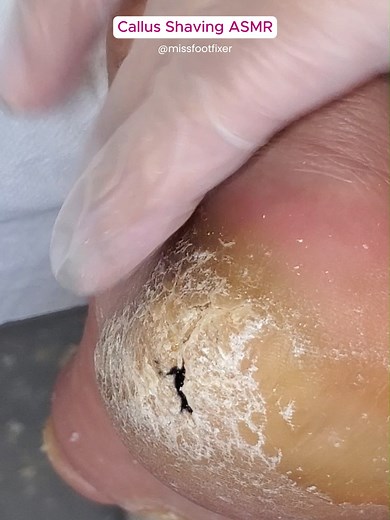 Satisfying Callus Shaving ASMR for Soft, Pain-Free Feet