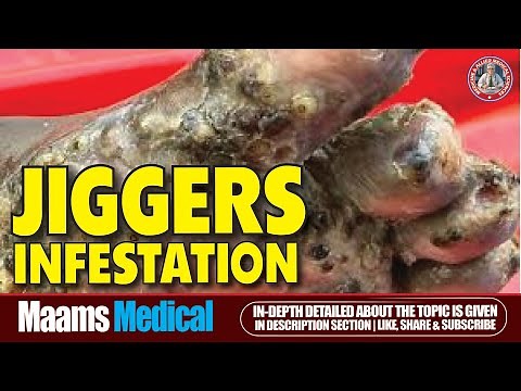Jigger Infestation Treatment: Step-by-Step Foot Care Guide
