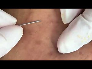cysts and blackheads this week , blackheads , cystic acne extraction , big blackheads #001