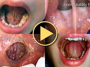 Tongue-Tie Release with Post-Op Healing Progression Photos - Video