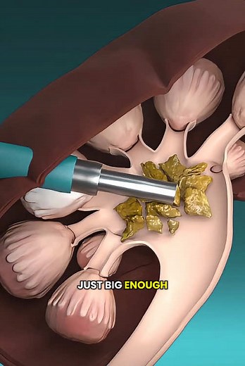 Kidney Stones Removal Surgery: Understanding PCNL Procedure
