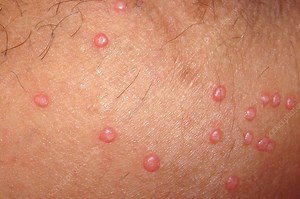 Bumpy But Benign: A Guide to Molluscum Contagiosum in Children