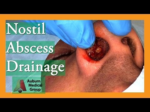 Nostril Abscess Drainage | Auburn Medical Group