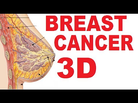 Breast Cancer - Lump Symptoms, Mastectomy, Mammogram - Breasts #3