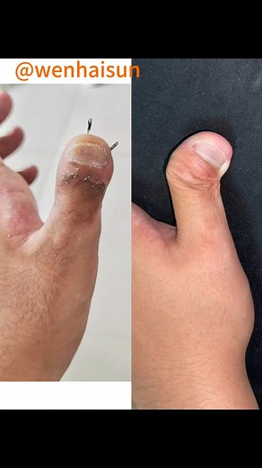 Clinodactyly(M-shaped flap). #clinodactyly #handsurgery | Wenhai Sun