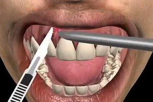 1.1K views | treatment of tooth abscess. | Dr.Tanveer's Dental Surgery | Facebook