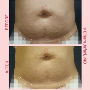 👁 Non-surgical reduction of stubborn fat __ 💉 Procedure: SculpSure (WarmSculpting) __ 🎯 Purpose: SculpSure is an FDA-approved laser for reduction of excessive stubborn fat in problem areas such as tummy, flanks, back, love handles, muffin tops, bra bulges, bra lines and more __ 💊 How it works: A specific laser that passes through the skin without affecting it and is absorbed selectively by the fat cells under the skin, destroying them for good! __ 🌹 Results: Many patients see results in 6-1