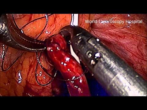 Laparoscopic Pyeloplasty at World Laparoscopy Hosoital