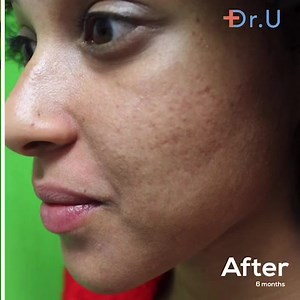 Acne scars be gone! . After a successful fraxel dual laser treatment...