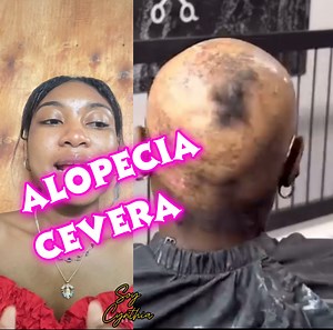 1.9K views · 33 reactions | Cambio total alopecia | Soy cynthia | Facebook