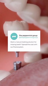 Dental Implant Benefits 🤍Dental implants are an investment, both for your oral health and self-confidence, with many benefits: 🤍Permanent: Dental implants are a fixed, long-lasting solution in which you can be 100% confident. Natural: Crowns are individually designed and colour-matched to your teeth for a natural smile. 🤍Empowering: Dental implants restore your bite so that you can enjoy all your favourite foods again. 🤍Restorative: Dental implants stimulate your jawbone, helping to prevent 