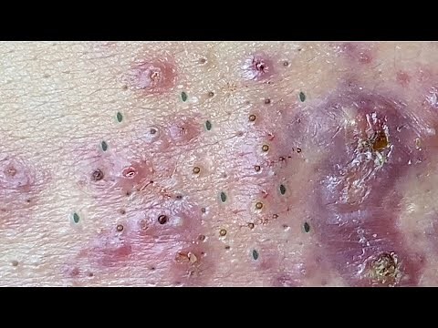 Relax Every Day With Loan Nguyen Spa | Acne Treatment Pimple Popping #46