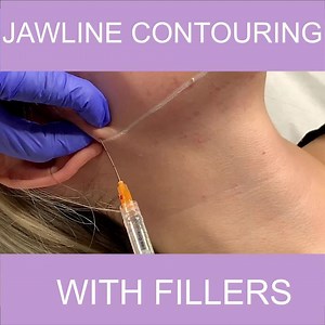 Jawline Contouring