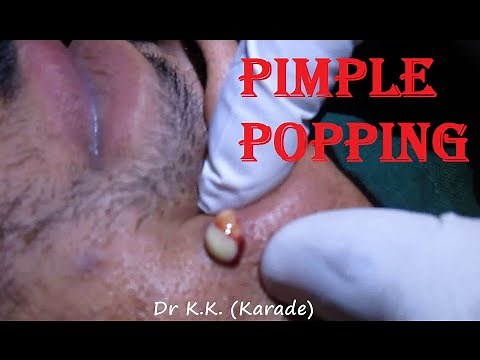 Huge Infected Pimple Popping on Face : Incision & Drainage of infected Cysts (INFLAMMATORY ACNE)