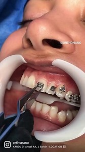 Self-Ligating brackets. With these Self-ligating Brackets we can do faster treatments, with lighter forces, which translates into a more comfortable treatment. Case by @orthonano  . . #Orthonano #Odontologo #Ortodoncia #Ortodoncista #Dentist #OrtodonciaReal#SonrisasReales #ortodontia #SonrisasPerfectas #Maracaibo #alejandrourdaneta #odontologos #ortodoncista #orthodontics #orthodontist #dentalvideo #dentalpicture | Dentistry blog | Facebook