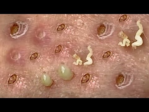 Unbelievable blackhead removal 2022 || Newest blackhead removal videos 2022
