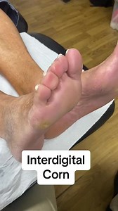 Watch and learn from our podiatrist as they demonstrate how a id hard corn is removed in the podiatry clinic #docpods #ergonx #corn #callus #satisfying #foot #feet #podiatrist #podiatry #australia | Piesperfectosmx