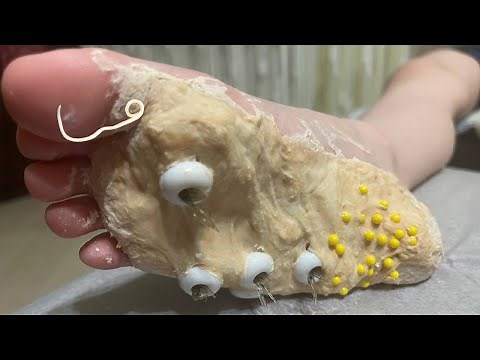 Removal of parasites from the holes on the sole of the foot