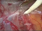 Laparoscopic Bilateral Pelvic Lymphadenectomy for Carcinoma Endometrium • Video • MEDtube.net