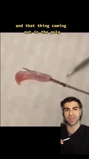 Removing Nerve From Tooth