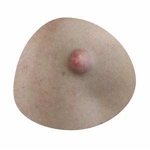 Cyst Removal - LipomaCyst.com | Lipoma & Cyst Specialists