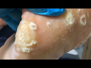 Remove Calluses From Soles Of Feet And Remove Dead Skin