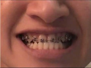 VLOG 9: Underbite