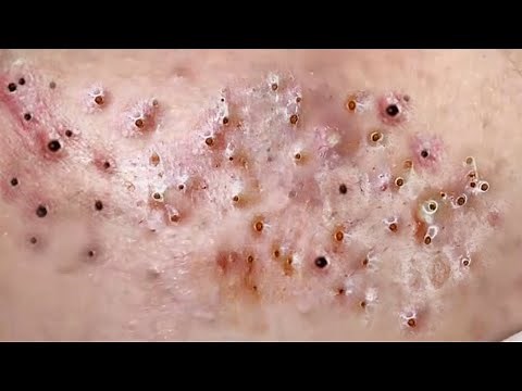 Treatment of Blackheads and hidden acne on cheeks At Sac Dep Spa