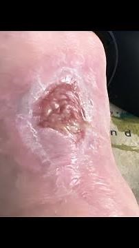 Video large boil, popping aftermath, part two