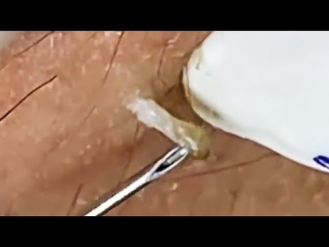 Extraction profonde des points noirs Acné kystique et popping #26