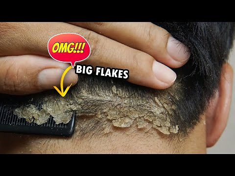 Big Dandruff Flakes Scalp Scratching And Picking Satisfying #378