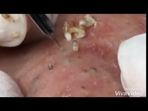 Pimple Popping 2020 Video #33| Blackhead removal, Whitehead removal, acne removal acne treatment