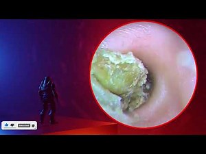 The Truth About earwax Will Shock You. How to remove earwax from ear, earwax extractions