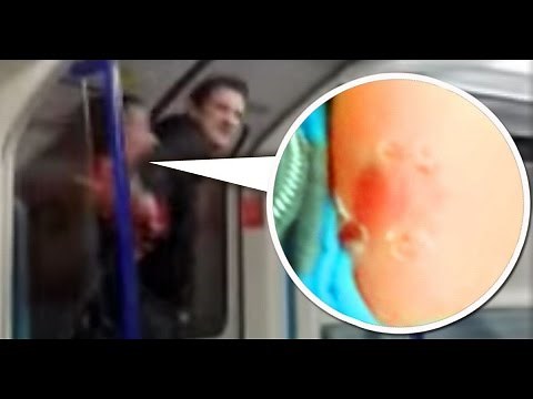 WOMAN BITES MAN 'S ARM IN LONDON DISGUSTING