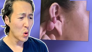 Plastic surgeon reacts to Dr. Pimple Popper: Ear keloids