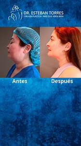 liposuccion de papada Procedimiento ambulatorio minimamente invasivo,que ayuda a redefinir el contorno facial, eliminando el exceso de grasa. Si lo estas pensando, te invito a mi consulta a resolver dudas y plantear tus espectativas. Recuerda siempre que la informacion es la clave para tomar una buena decisión. Los espero.☺️ #liposuccion #papada #lipopapada #perfiladorostro #hombre #mujer | Dr. Esteban Torres Egaña