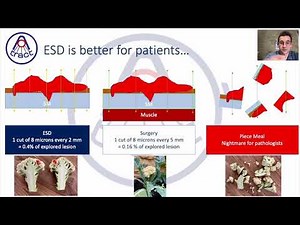 Welcome to ESD School! Mastering Endoscopic Submucosal Dissection