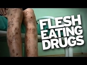 Flesh Eating Drug "Krokodil" Hits U.S.!
