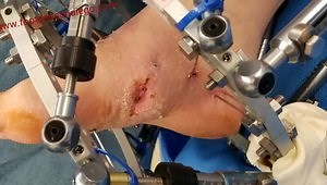Charcot Foot Deformity and Reconstruction in a Diabetic Foot