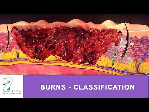 BURNS - CLASSIFICATION