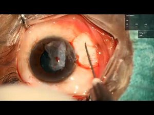 Pterygium surgery with conjunctival autograft using fibrin glue.