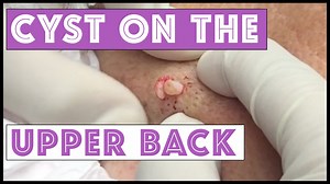 Epidermoid cyst on Upper Back removed via Punch Biopsy Tool