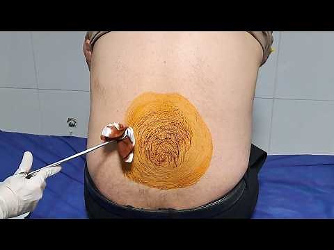 Lumbar puncture & measuring Brain Pressure - Aspirating spinal fluid