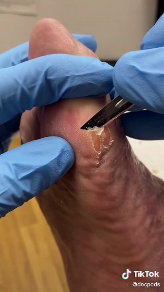 Professional Callus Removal by Podiatrist