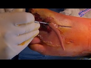 Draining abscess from a diabetic foot infection | Dr. Nicholas Campitelli