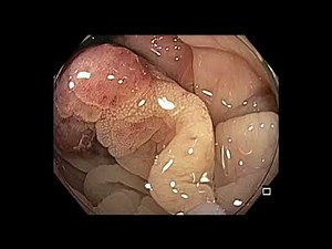 Colonoscopy: Sigmoid Colon Pedunculated Polyp Resection • Video • MEDtube.net